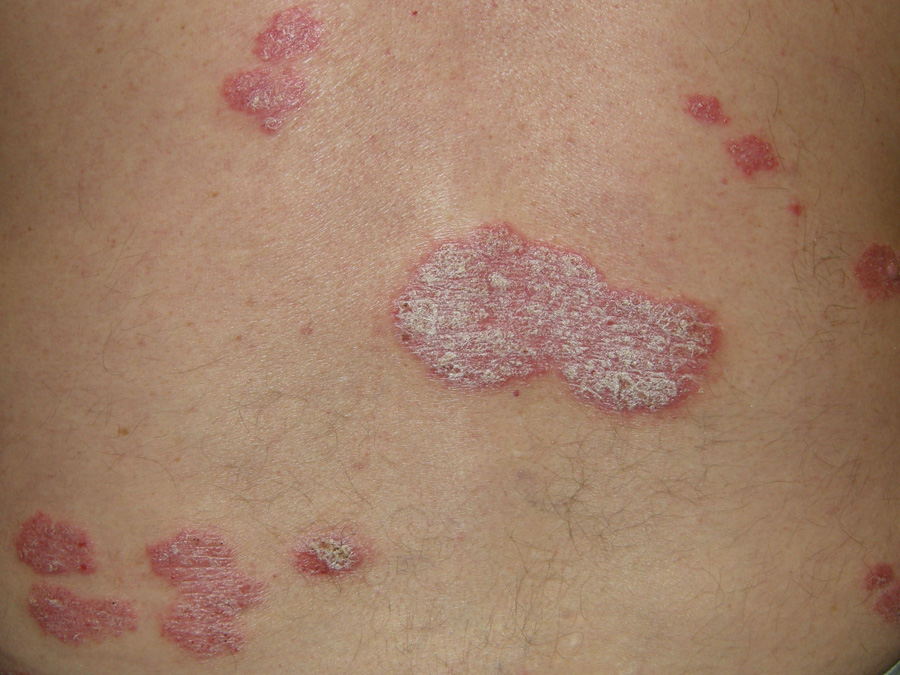 Chronic plaque psoriasis an overview of treatment in