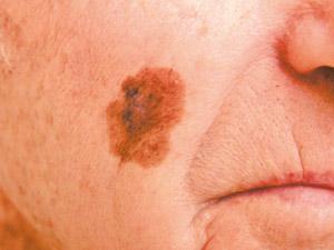 Lentigo maligna melanoma, © DermNet NZ