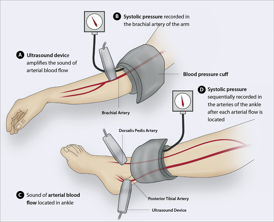 Ankle Brachial Index