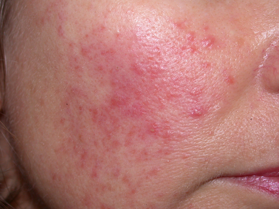 Rosacea Seeing Red In Primary Care Bpj 75 May 2016