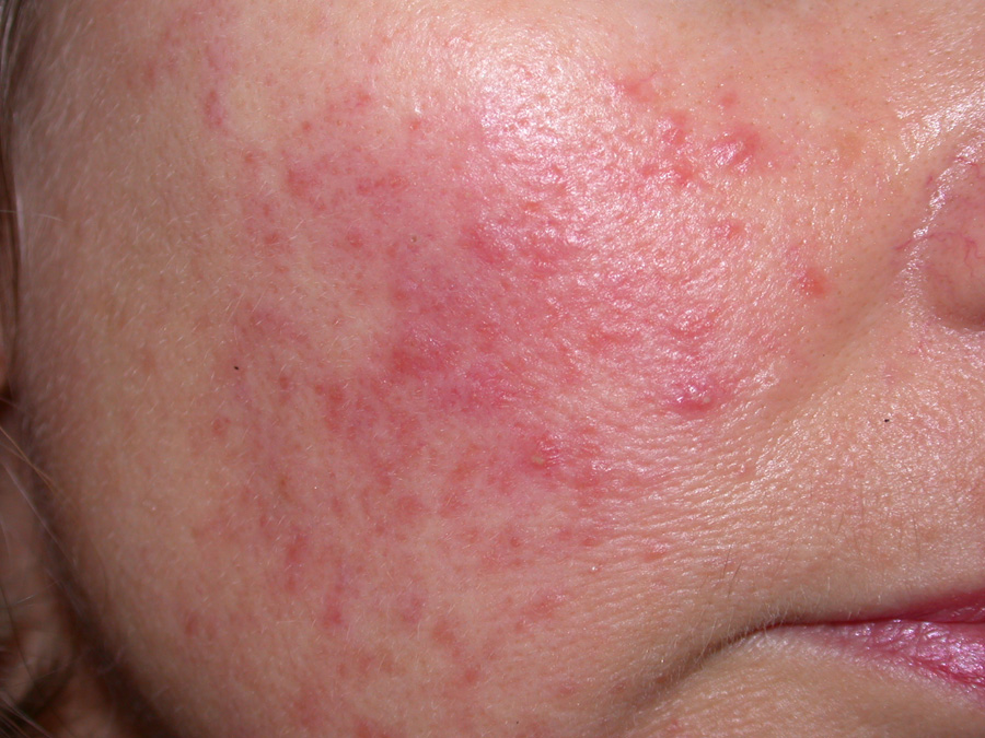 Rosacea Seeing Red In Primary Care BPJ 75 May 2016