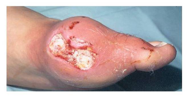 Figure 1: An ulcerated tophus