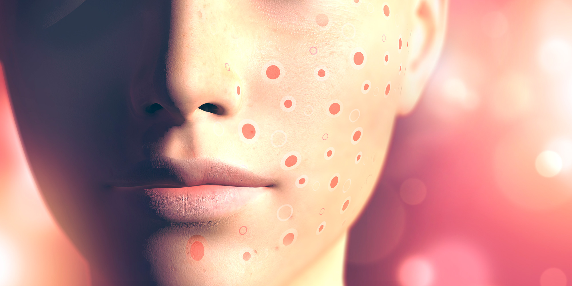 Prescribing Isotretinoin For Patients With Acne In Primary Care Best 