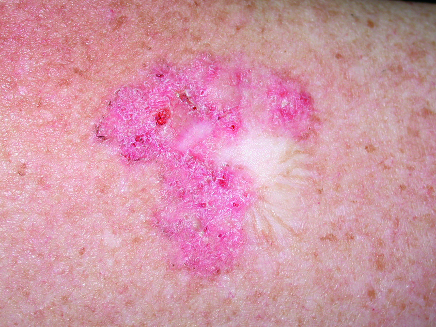 Superficial basal cell carcinoma (BCC)