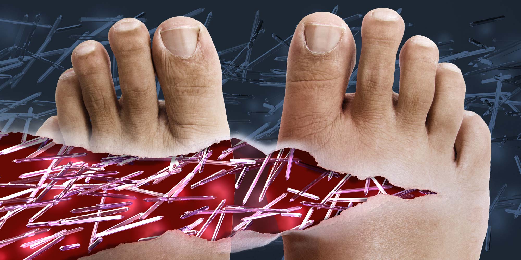 Can you still get gout while taking allopurinol joint pain