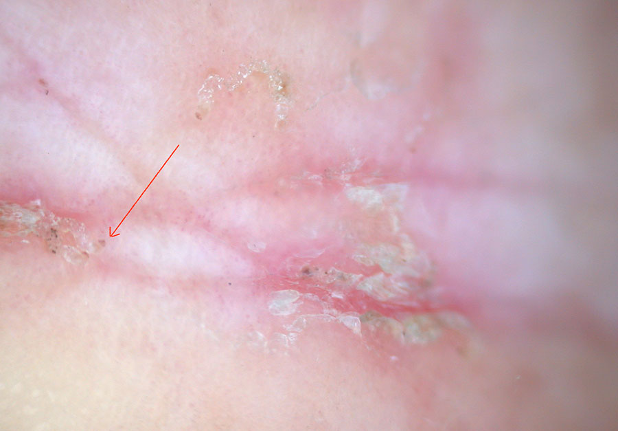 Scabies: diagnosis and management - bpacnz