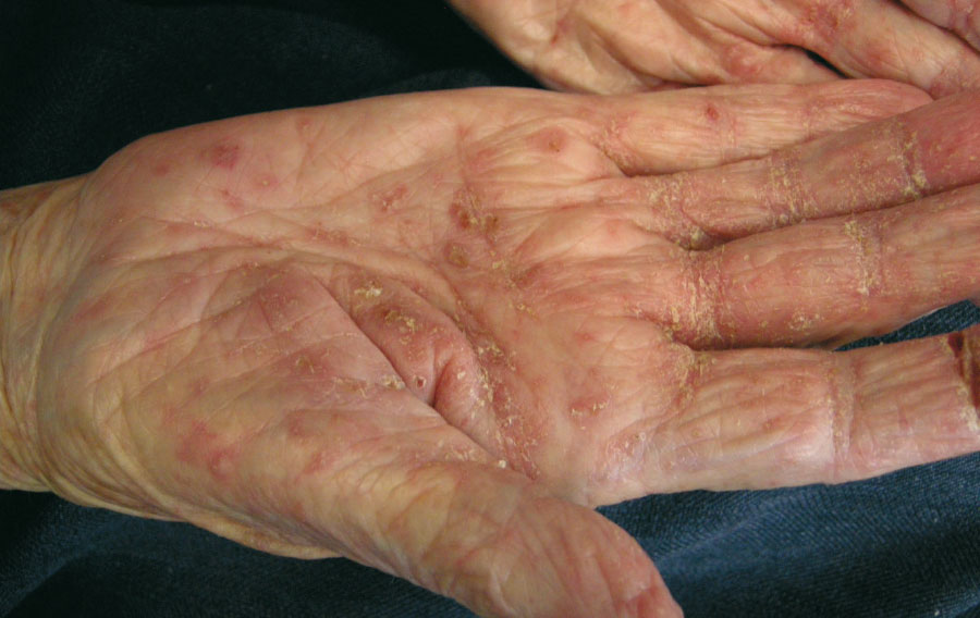 Scabies-induced hyperkeratosis of the hands