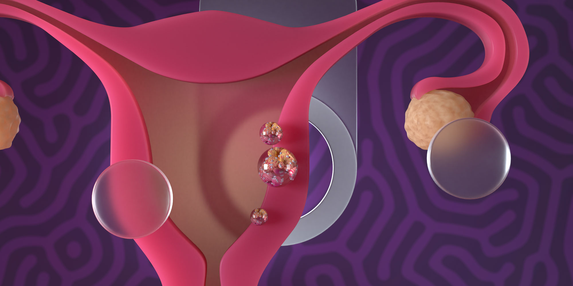 Endometrial cancer – early detection and referral 