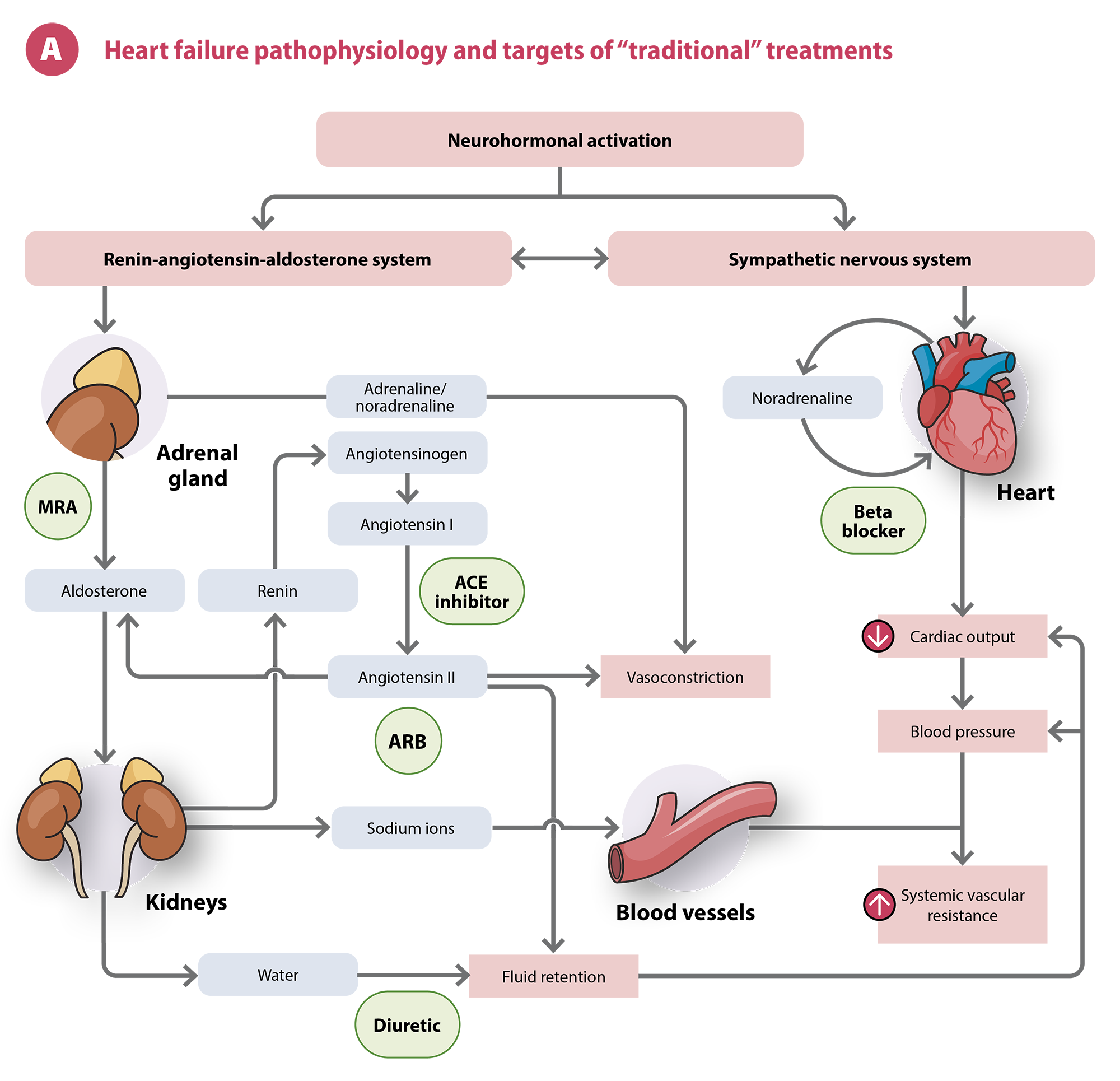 Congestive Heart Failure Diagram