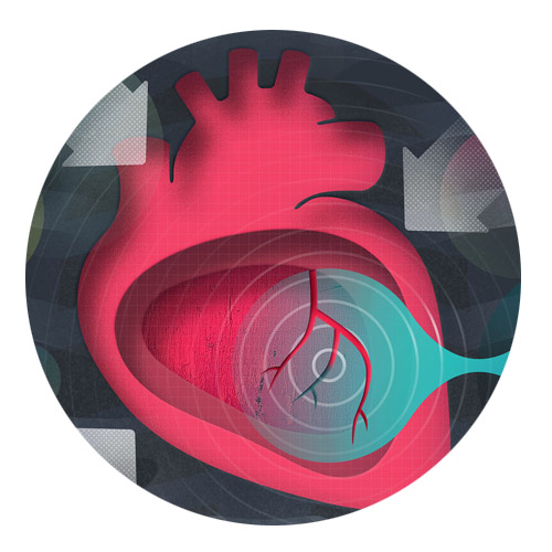 stable angina pectoris