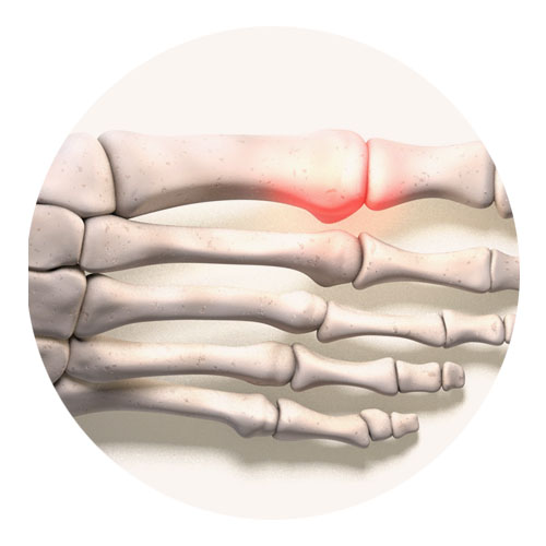 Gout Case Study