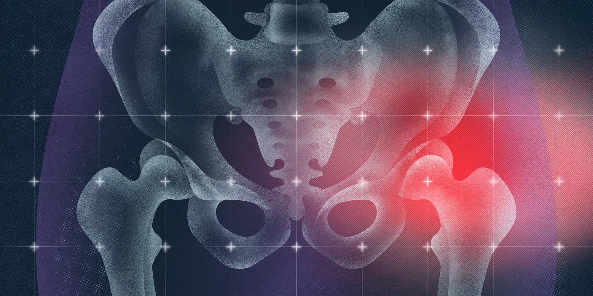 Upfront: Hip dysplasia in adolescents and young adults