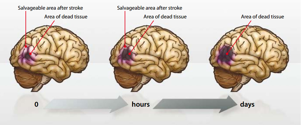 Time Is Brain Emergency Treatment Of Stroke Bpj 26 March 2010