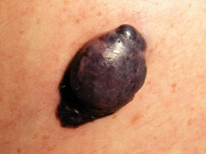 Nodular melanoma, © DermNet NZ