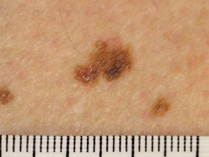 Superficial spreading melanoma, © DermNet NZ