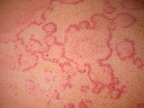 Urticaria Annular Pattern 