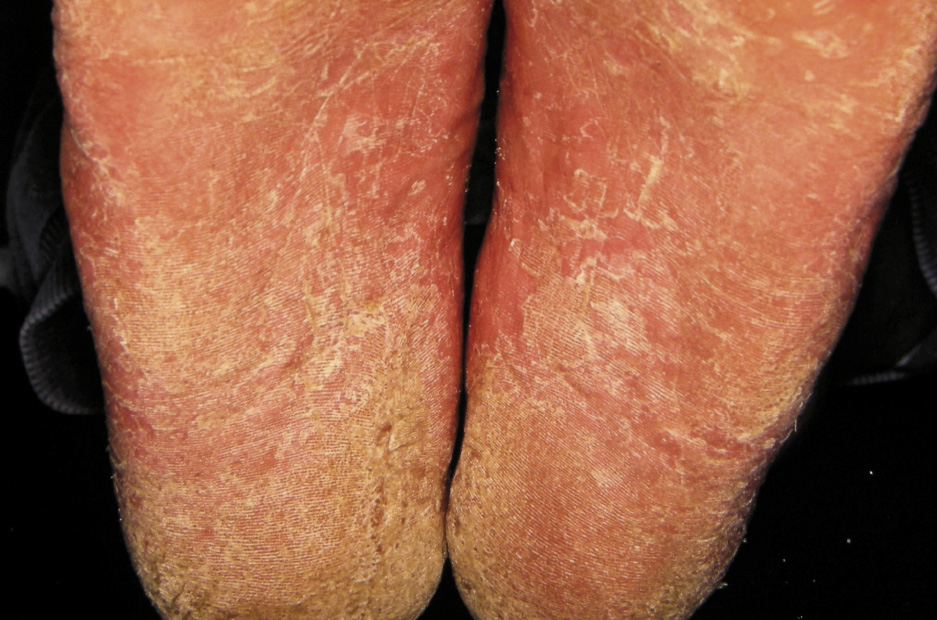 Tinea Pedis Not Just The Curse Of The Athlete Bpj65 December 2014