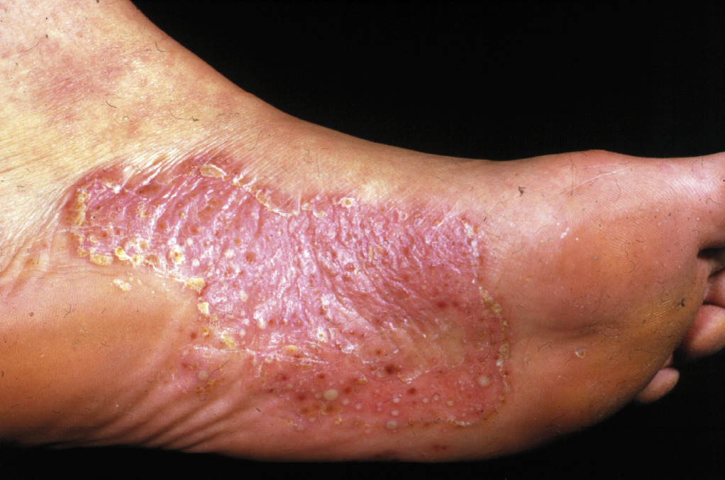 Palmoplantar pustulosis (palmoplantar pustular psoriasis) .