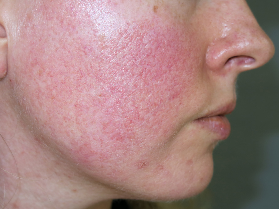 Rosacea Pictures 91