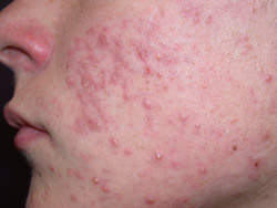 Moderate acne