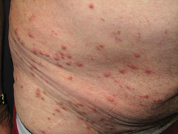 Scabies Diagnosis And Management Bpj 19 February 2009
