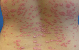 psoriasis derm net a tenyerét vörös foltok és viszketés borítják