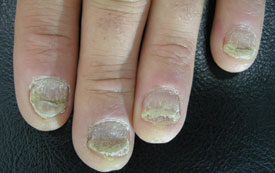 dermnet psoriasis nail)