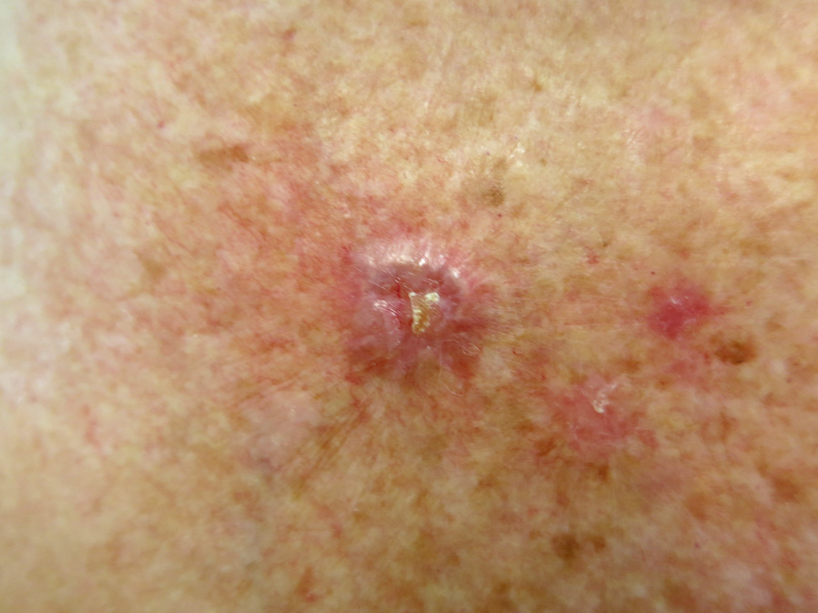 nodular melanoma flesh colored
