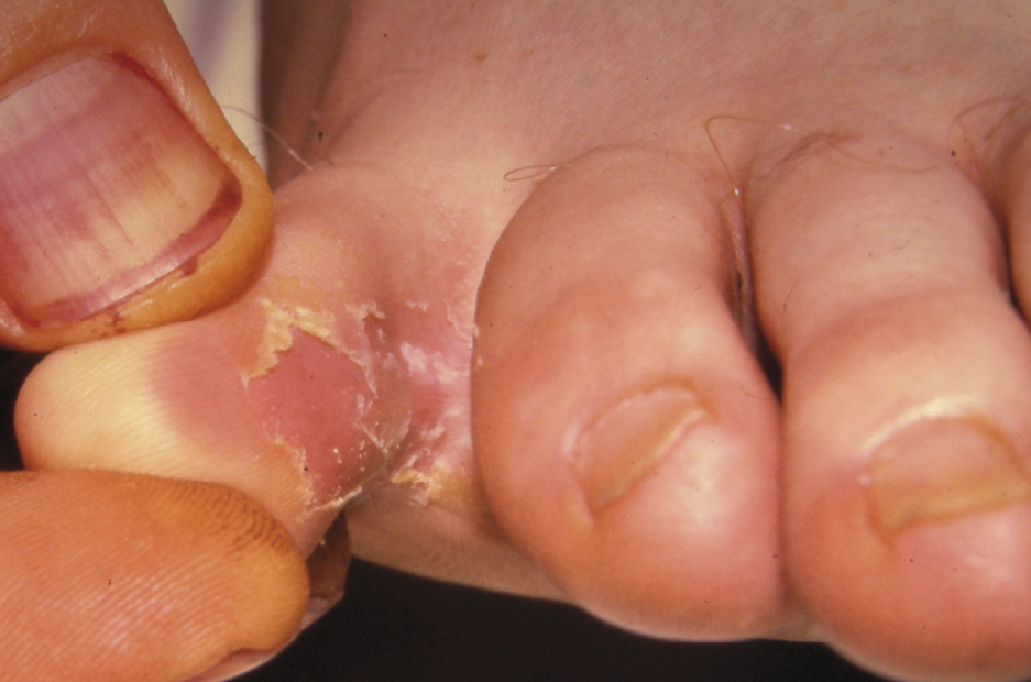skin fissure between toes