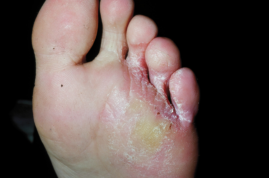 Tinea pedis (fungal foot infection)