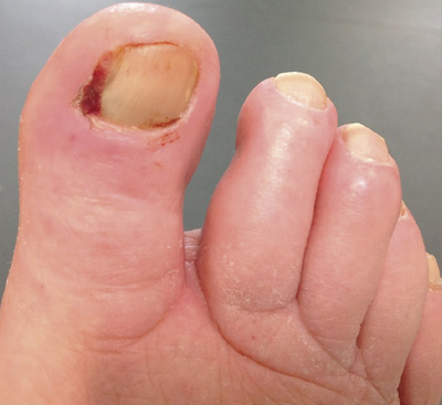 Tinea pedis: not just the curse of the athlete - BPJ65 December 2014