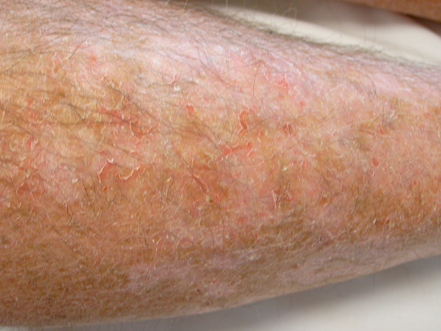 sun damaged skin on legs