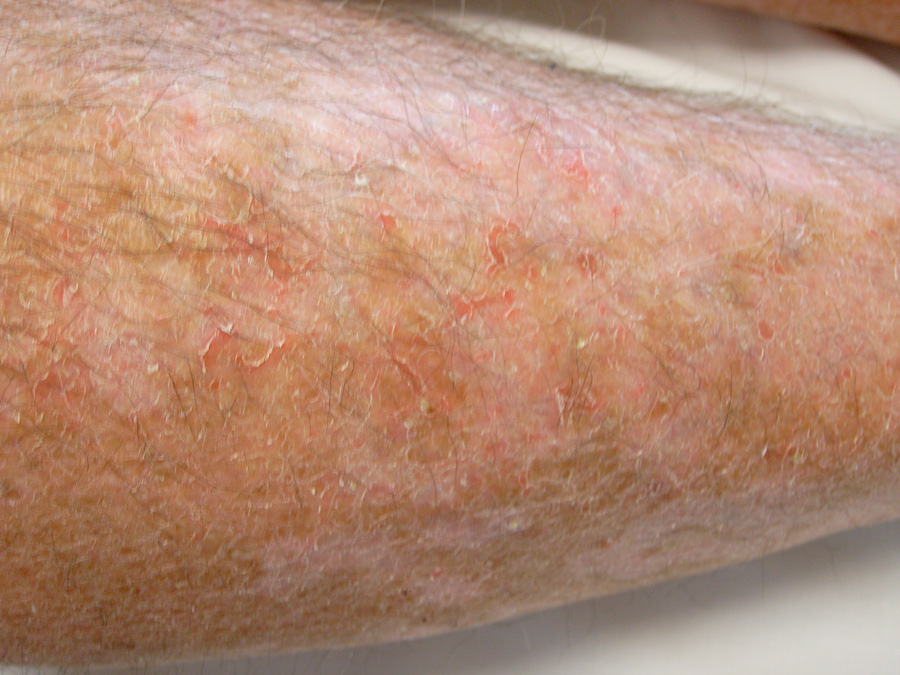 dry cracked skin on legs