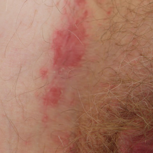 Edema of the vulva and mons pubis, followed by ill-defined erythema and