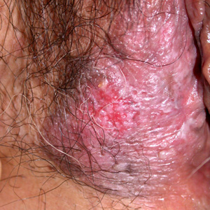 Swollen vagina or vulva